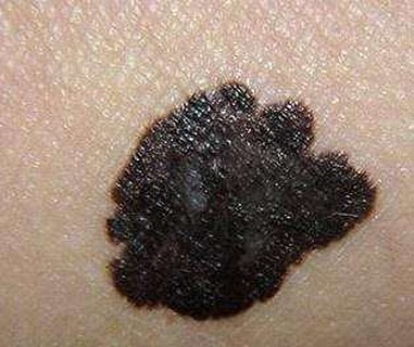 <strong>黑毛痣胎记的注意事项和治疗方法，南京治疗黑毛痣胎记有哪些医院？</strong>