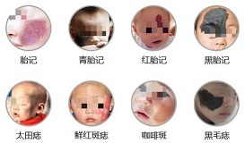 <strong>宝宝的哪些胎记会随着年龄加深？南京在哪里能治疗宝宝身上的胎记？</strong>