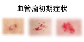 <strong>血管瘤胎记初期表现有哪些？早了解早安心！</strong>