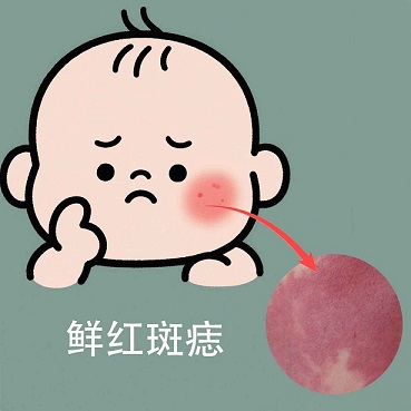 <strong>宝宝胎记变大怎么办？南京哪家医院看胎记好？</strong>