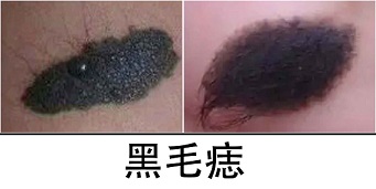 <strong>黑毛痣胎记有什么危害？看完你还敢忽视吗？</strong>