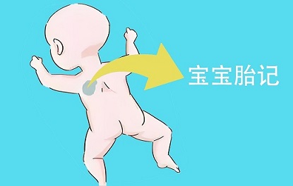 <strong>宝宝胎记的饮食注意事项，你了解吗？</strong>