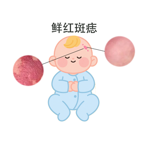 <strong>长鲜红斑痣的人需要注意什么？南京哪个医院看胎记比较好？</strong>
