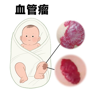 南京资讯一览：血管瘤出现在皮肤显眼位置怎么办？